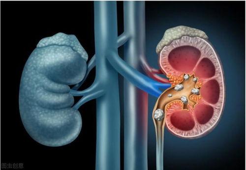 肾结石按摩在线视频,轻松缓解疼痛，专业指导助您康复