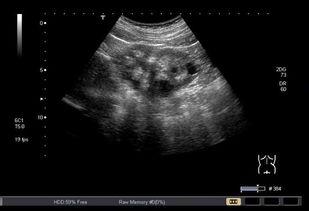 双肾b超在线视频,清晰展现肾脏健康状态