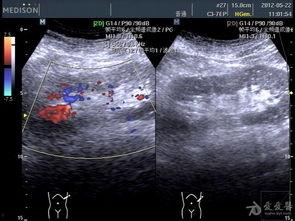 双肾b超在线视频,清晰展现肾脏健康状态